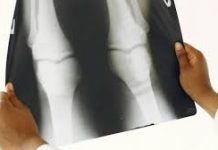 «Ζωντανά» εμφυτεύματα χόνδρου για αποκατάσταση βλαβών σε αρθρώσεις